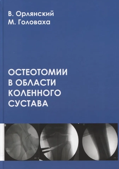 Остеотомии в области коленного сустава: купить с доставкой по Кипру или в книжных магазинах Букберри в Лимасоле, Ларнаке и Пафосе